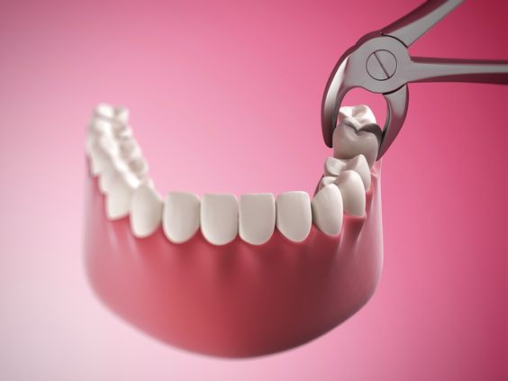 How Long Should You Wait to Exercise After Tooth Extraction